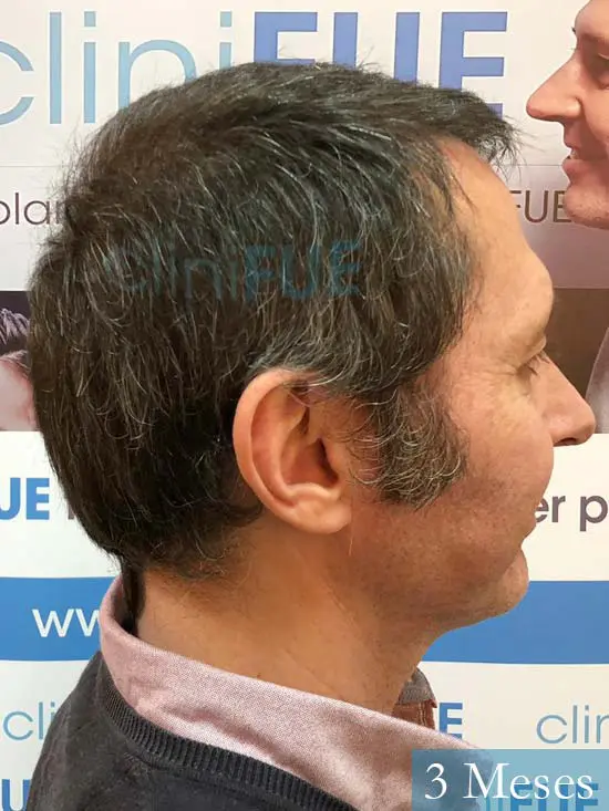 Cristobal 46 Bilbao injerto capilar turquia 3 meses desde trasplante de pelo 