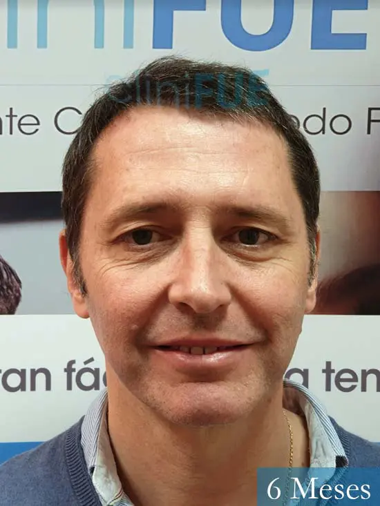 Cristobal 46 Bilbao injerto capilar turquia 6 meses desde trasplante de pelo 