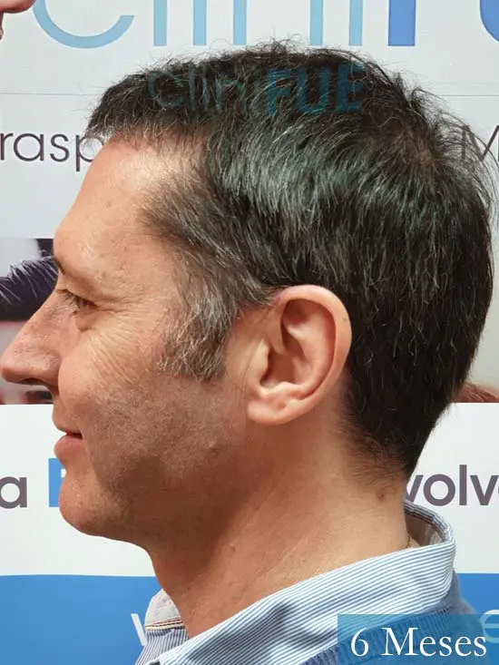 Cristobal 46 Bilbao injerto capilar turquia 6 meses desde trasplante de pelo 