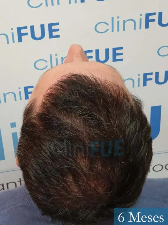 Cristobal 46 Bilbao injerto capilar turquia 6 meses desde trasplante de pelo