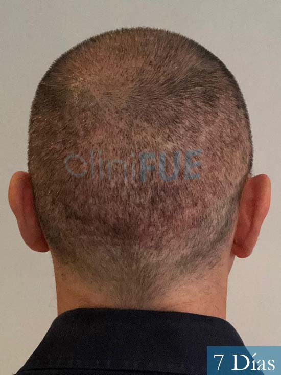 Cristobal 46 Bilbao injerto capilar turquia 7 dias desde trasplante de pelo