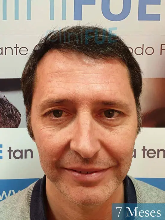 Cristobal 46 Bilbao injerto capilar turquia 7 meses desde trasplante de pelo 