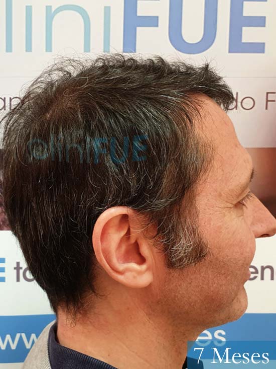 Cristobal 46 Bilbao injerto capilar turquia 7 meses desde trasplante de pelo 