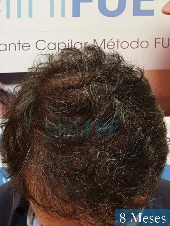Cristobal 46 Bilbao injerto capilar turquia 8 meses desde trasplante de pelo 