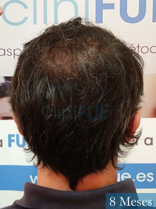 Cristobal 46 Bilbao injerto capilar turquia 8 meses desde trasplante de pelo 