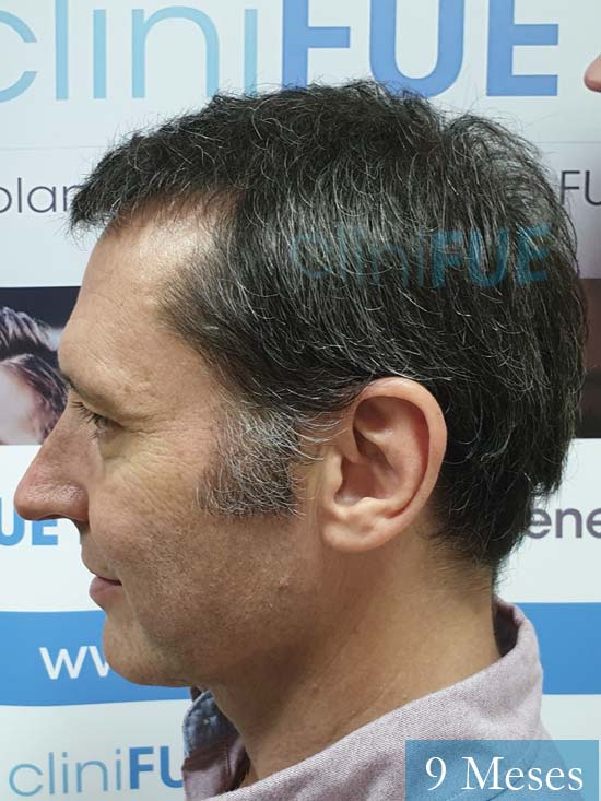 Cristobal 46 Bilbao injerto capilar turquia 9 meses desde trasplante de pelo 
