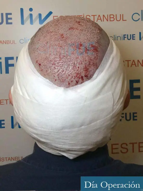 Cristobal 46 Bilbao injerto capilar turquia dia operacion