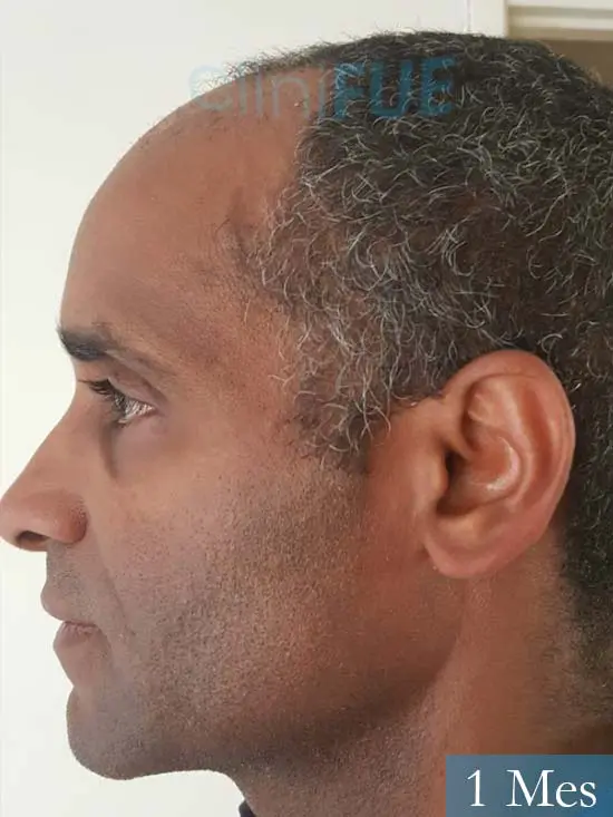 Juan Manuel 52 años injerto capilar turquia primera operacion 1 mes 4