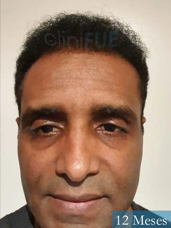 Juan Manuel 52 años injerto capilar turquia primera operacion 12 meses 1