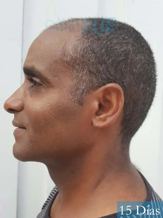 Juan Manuel 52 años injerto capilar turquia primera operacion 15 dias 4