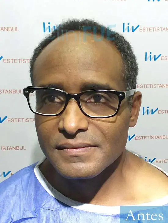 Juan Manuel 52 años injerto capilar turquia primera operacion dia operacion antes 