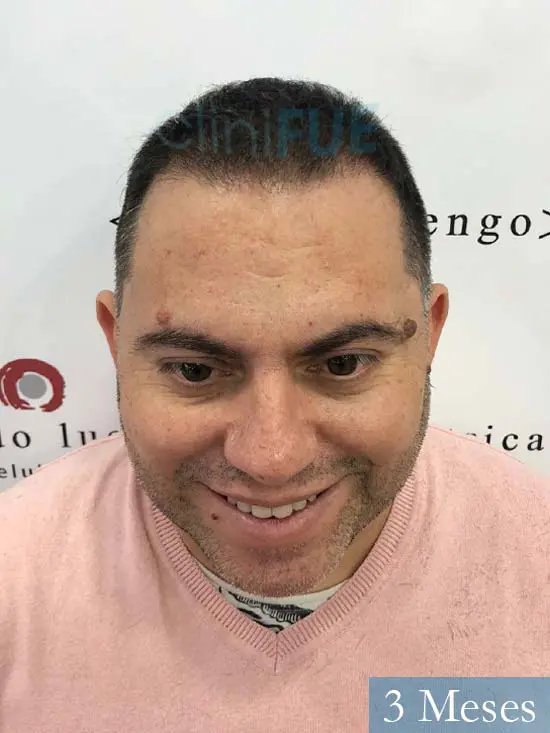 Ricardo injerto de pelo dia operacion 3 meses 
