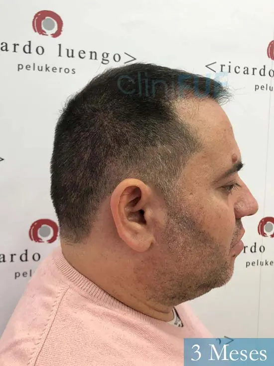 Ricardo injerto de pelo dia operacion 3 meses 3