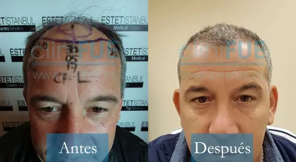 Trasplante capilar de Fernando 46 Años Málaga en Turquía con cliniFUE