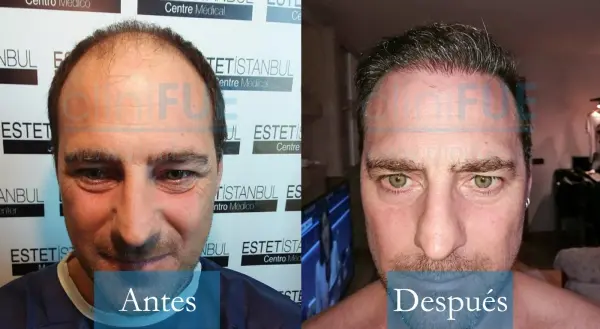 Trasplante capilar de José Luis 42 Años de Barcelona con cliniFUE