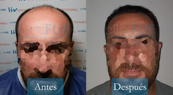 Trasplante capilar de Juan Antonio 41 Años de Málaga con cliniFUE