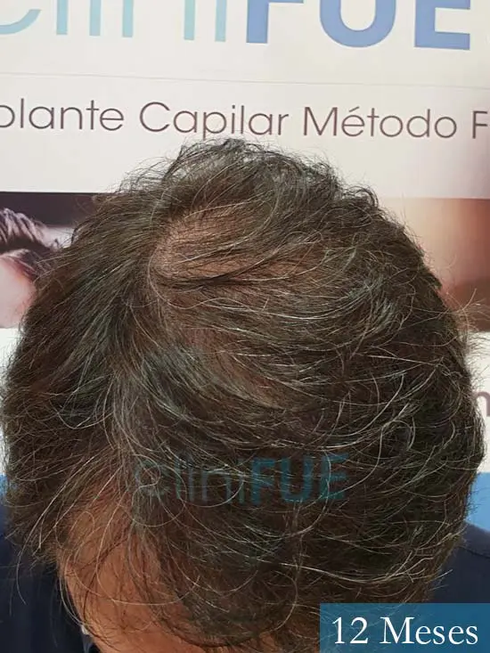 Cristobal 46 Bilbao injerto capilar turquia 12 meses desde trasplante de pelo 