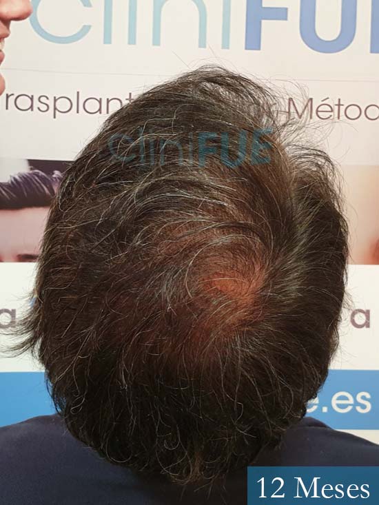 Cristobal 46 Bilbao injerto capilar turquia 12 meses desde trasplante de pelo 