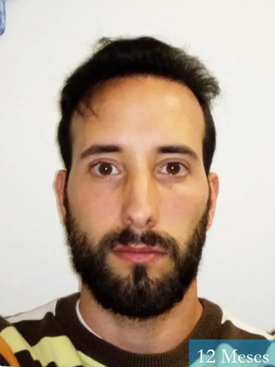 Jonathan 31 años Las Palmas trasplante capilar turquia 12 meses 