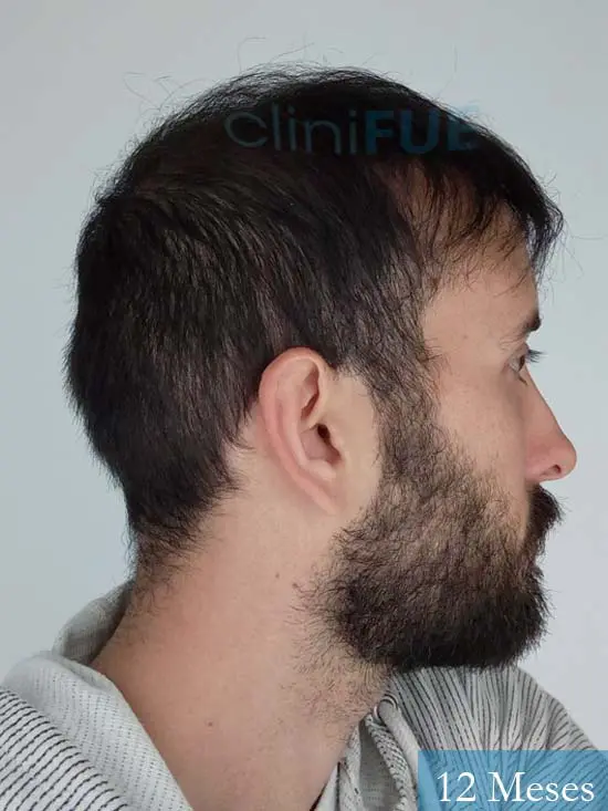 Jonathan 31 años Las Palmas trasplante capilar turquia 12 meses 4