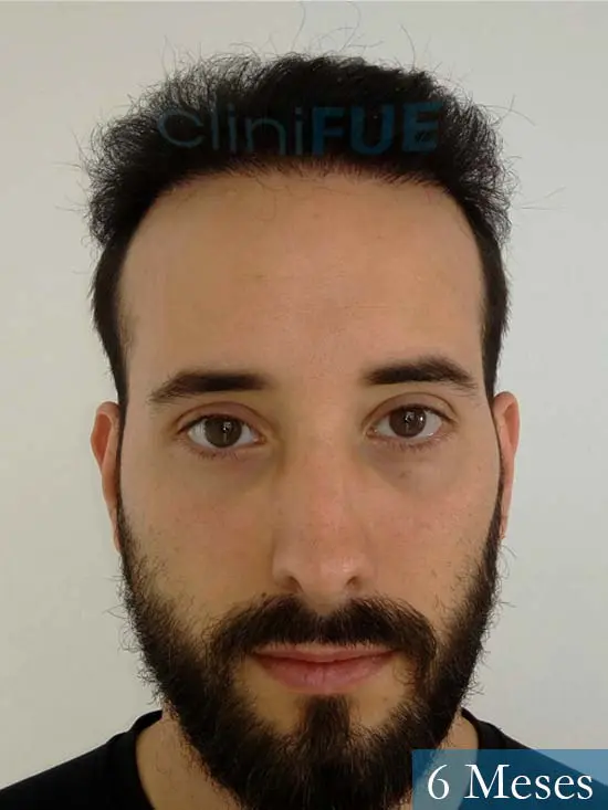 Jonathan 31 años Las Palmas trasplante capilar turquia 3 meses 