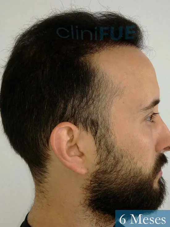 Jonathan 31 años Las Palmas trasplante capilar turquia 3 meses 3