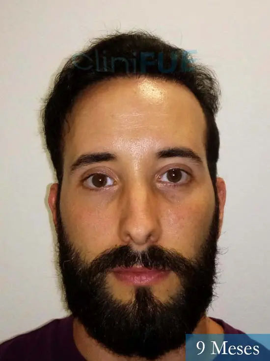 Jonathan 31 años Las Palmas trasplante capilar turquia 9 meses 