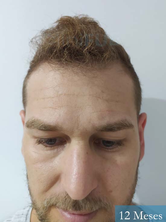 Victor 32años trasplante capilar turquia 12 meses