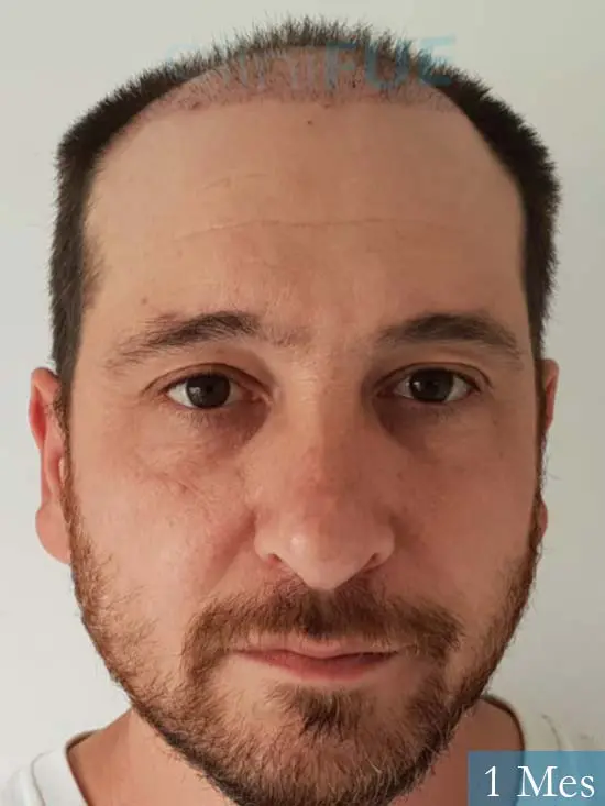 Javier 42 Barcelona trasplante capilar turquia 1 mes 