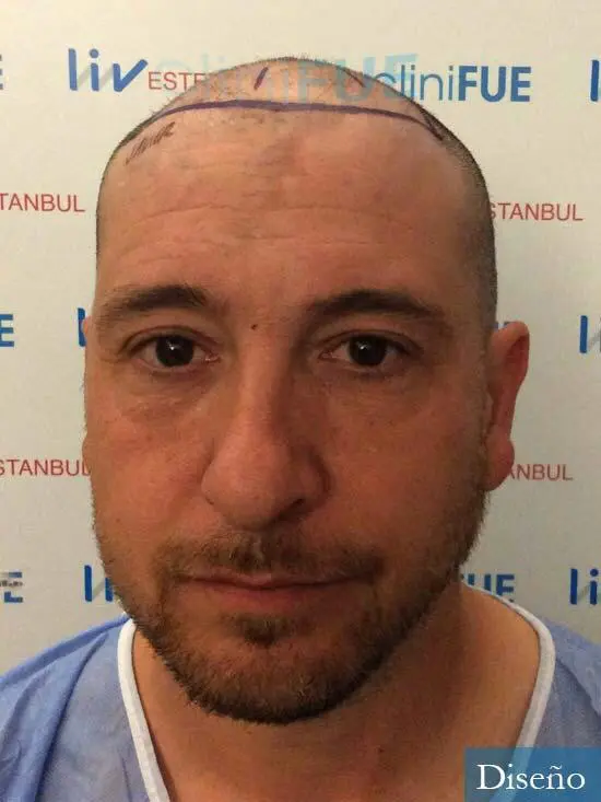 Javier 42 Barcelona trasplante capilar turquia dia operacion diseño 4