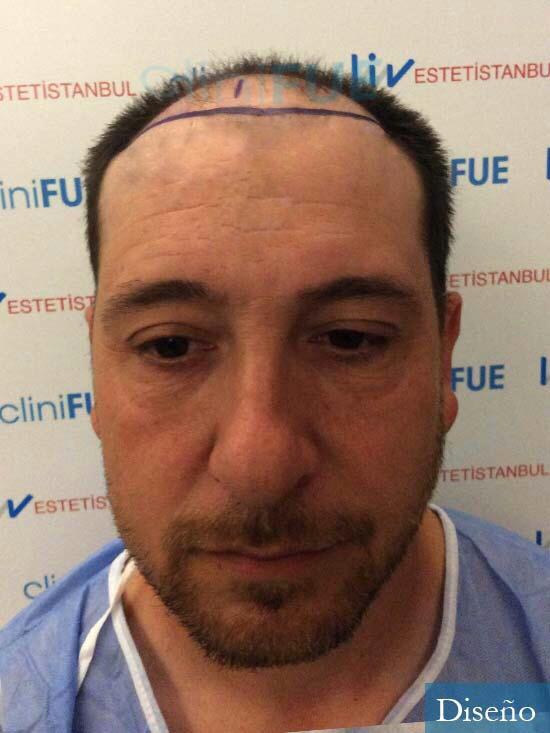 Javier 42 Barcelona trasplante capilar turquia dia operacion diseño 