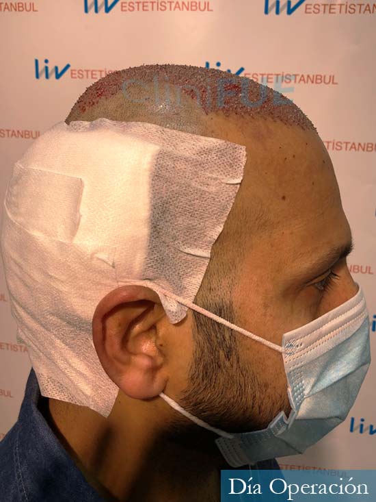 Muhammad 39 Barcelona trasplante capilar turquia dia operacion 3
