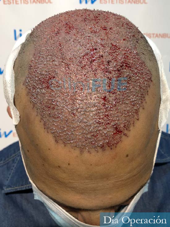 Muhammad 39 Barcelona trasplante capilar turquia dia operacion 2