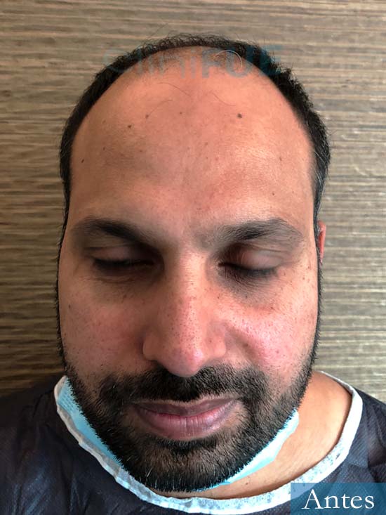 Muhammad 39 Barcelona trasplante capilar turquia antes 