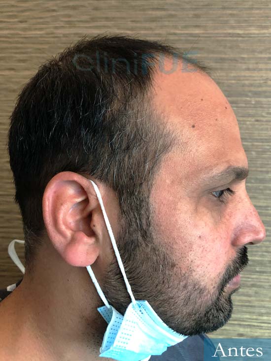 Muhammad 39 Barcelona trasplante capilar turquia antes 3