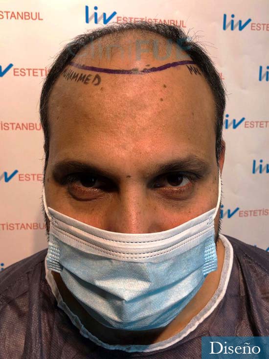 Javier 42 Barcelona trasplante capilar turquia dia operacion diseño 