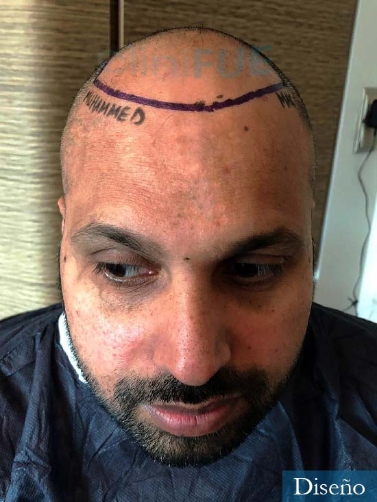 Muhammad 39 Barcelona trasplante capilar turquia antes 5