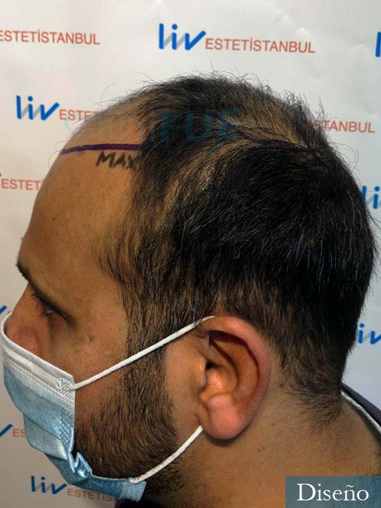 Muhammad 39 Barcelona trasplante capilar turquia antes 4
