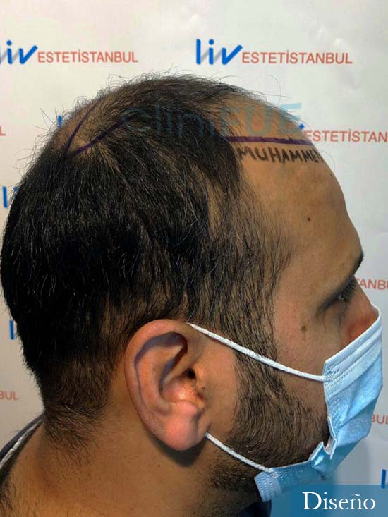 Muhammad 39 Barcelona trasplante capilar turquia antes 3