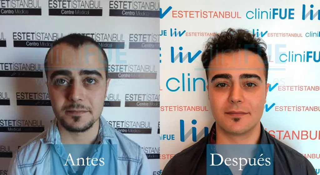 Trasplante capilar de Sinan 29 Años de Estambul con cliniFUE