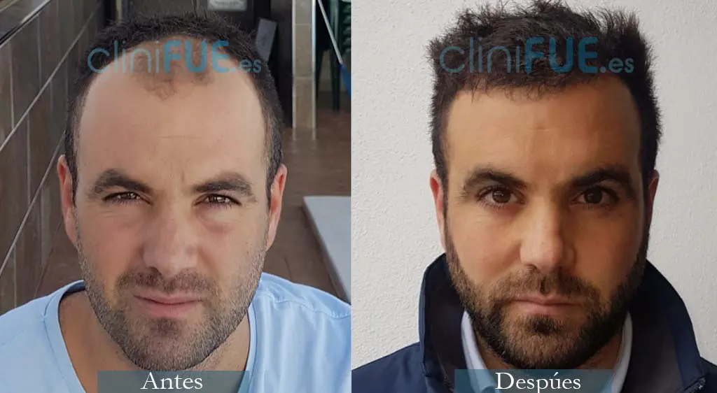 Trasplante Capilar de Alejandro 32 Años de Granada con cliniFUE