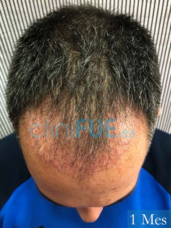 Guillermo 33 Albacete trasplante capilar turquia 1 mes