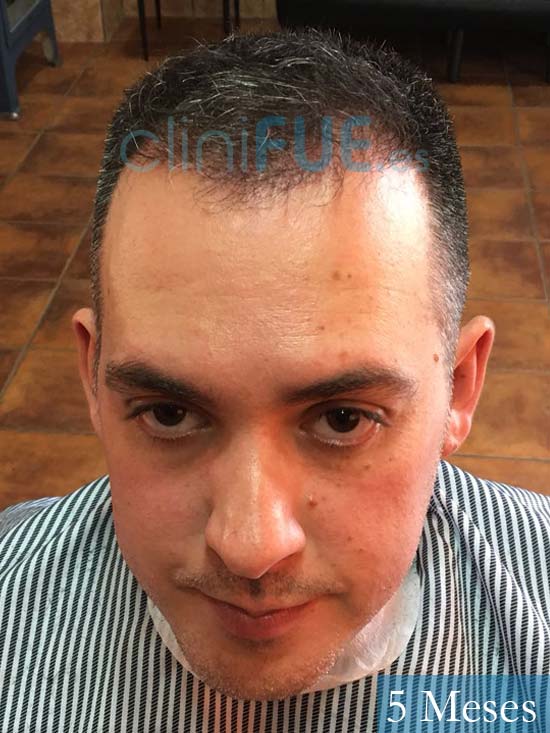 Guillermo 33 Albacete trasplante capilar turquia 5 meses 