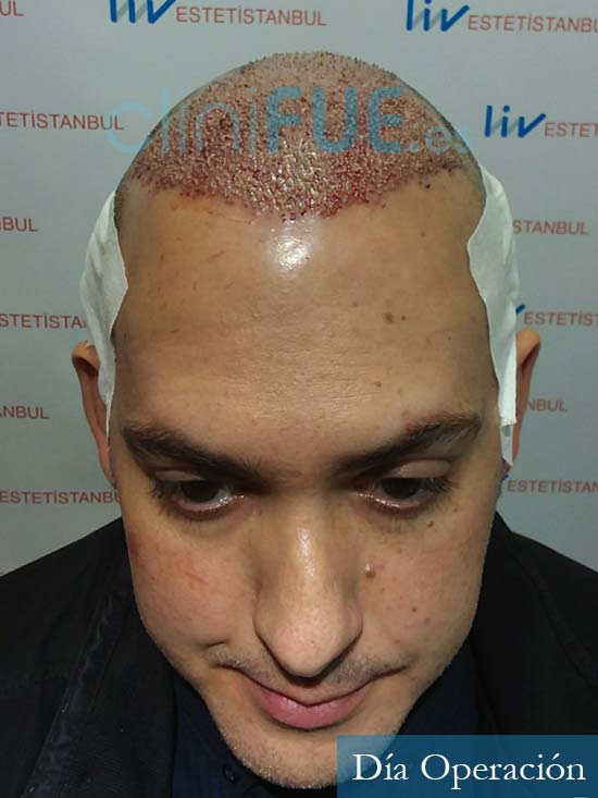 Guillermo 33 Albacete trasplante capilar turquia antes 