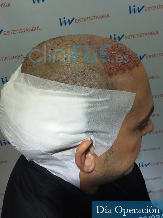 Guillermo 33 Albacete trasplante capilar turquia antes 3