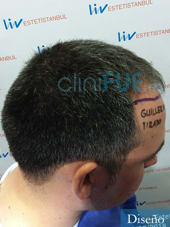 Guillermo 33 Albacete trasplante capilar turquia antes 