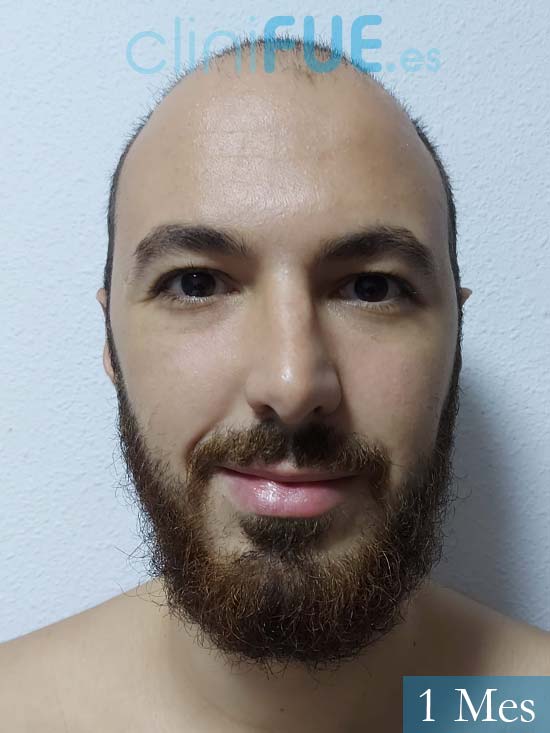  Sebastian 25 Valencia trasplante capilar turquia 1 mes 
