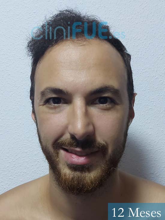 Sebastian 25 Valencia trasplante capilar turquia 12 meses 