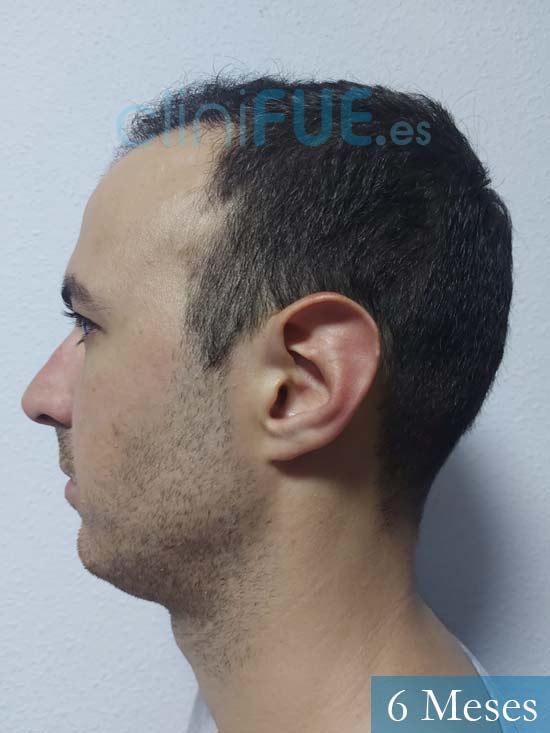 Sebastian 25 Valencia trasplante capilar turquia 6 meses 5