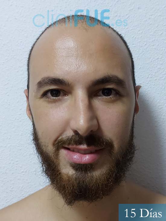 Sebastian 25 Valencia trasplante capilar turquia 15 dias 